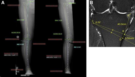 Preoperative Planning A Correction Angle Calculation With A Digital Download Scientific