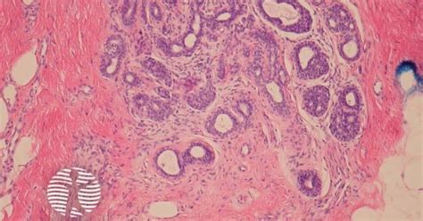 Dermnet Polymorphous Sweat Gland Carcinoma Pathology Image