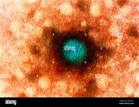 El Virus Del Herpes Simple Color Micrógrafo Electrónico De Transmisión Tem De Una Partícula