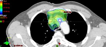 La Radioth Rapie Conformationnelle Avec Modulation D Intensit