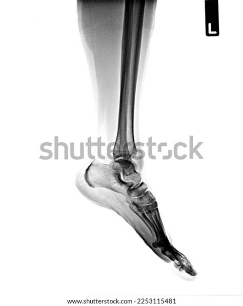 Xray Normal Human Leg Lateral View Stock Photo 2253115481 Shutterstock