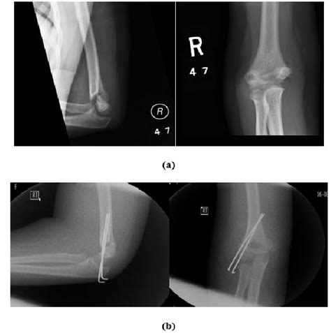 Type Ii Supracondylar Humeral Fractures In Year Old Girl A Ap And