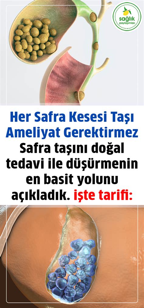 Her Safra Kesesi Taşı Ameliyat Gerektirmez Safra taşını doğal tedavi