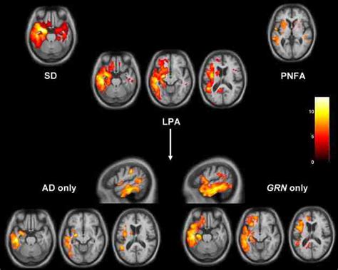 Vbm Analysis On Grey Matter Regions In Ppa Groups Relative To Healthy