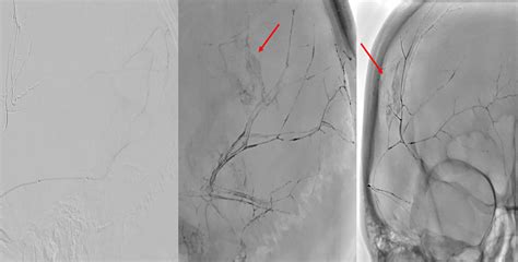 Middle Meningeal Artery Embolization For Chronic Subdural Hematoma A