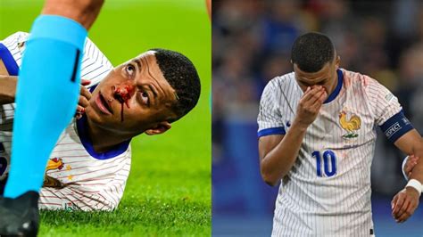 Mbappé suffered a very hard blow to the nose and could miss the rest of