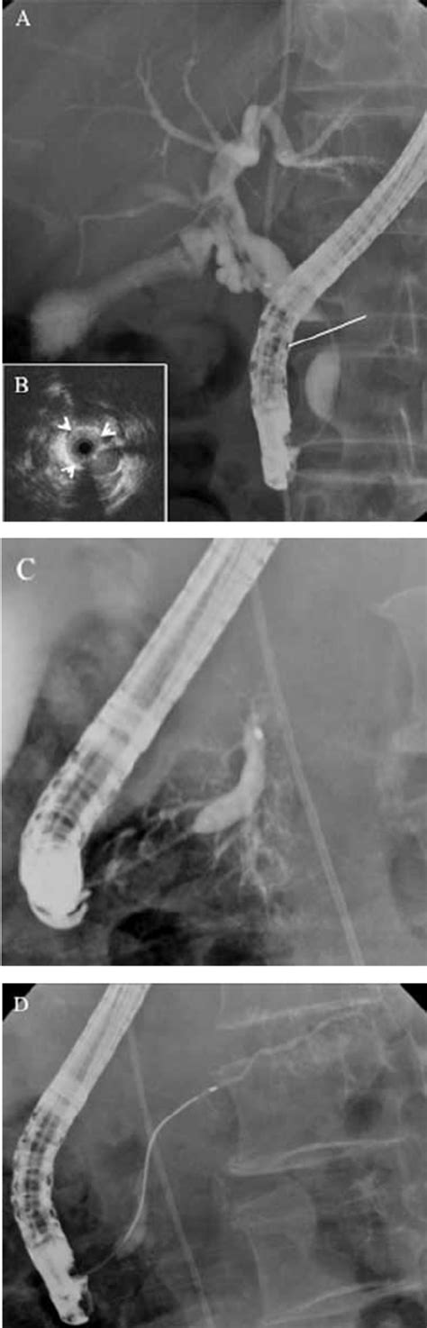 A Endoscopic Retrograde Cholangiogram Erc Showed A Stenosis Of The