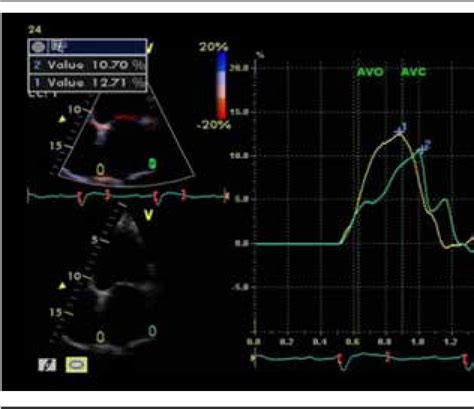 Figure From Comparison Of Left Atrial Function Between Hypertensive