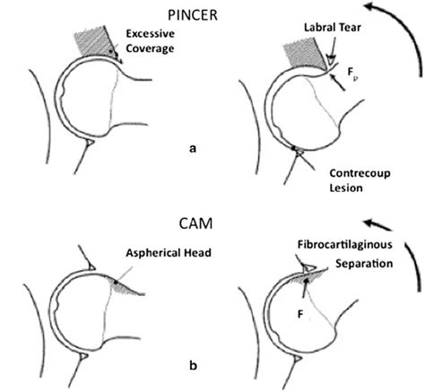 Types Of Tears Of The Labrum A Pincer Type Femoroacetabular Download Scientific Diagram