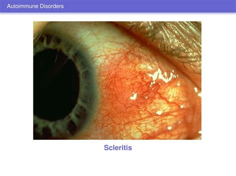 Ppt Ocular Manifestations Of Systemic Disease Powerpoint Presentation