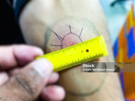 Mantoux Tuberculin Skin Test Closeup View Photography Of Patient Arm