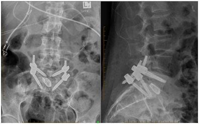 Minimally Invasive Transforaminal Lumbar Interbody Fusion MIsTLIF And