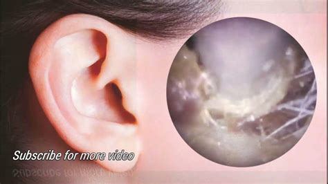 Satisfying Video Ear Wax Removal How To Remove Ear Wax Removal By Endoscopic Long Video Youtube