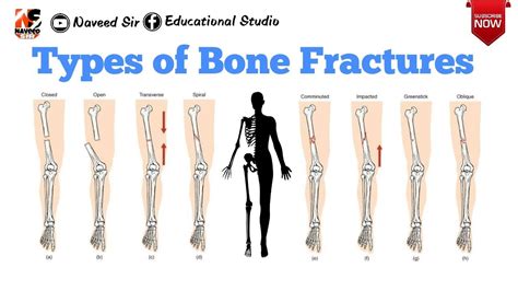 The Six Different Types Of Fractures