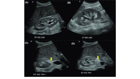 Ultrasound Of The Right Kidney Showing Mild Hydronephrosis