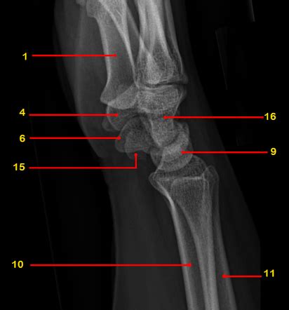 Wrist (lateral view) | Radiology Reference Article | Radiopaedia.org