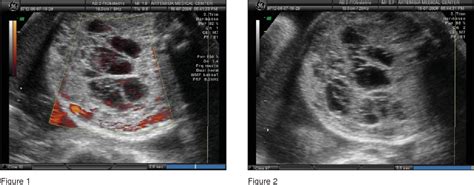 Figure From Fetal Hepatic Mesenchymal Hamartoma A Case Report