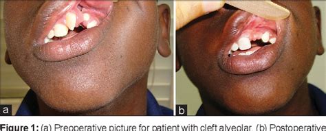 Figure 1 From Repair Of Cleft Alveolar Bone With Bioactive Glass