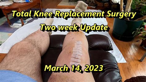 Total Knee Replacement Surgery Two Week Update March 14 2023 Youtube