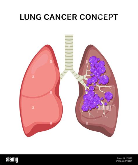 Lung Cancer Vector Concept Repiratory Disease Cartoon Human Lung