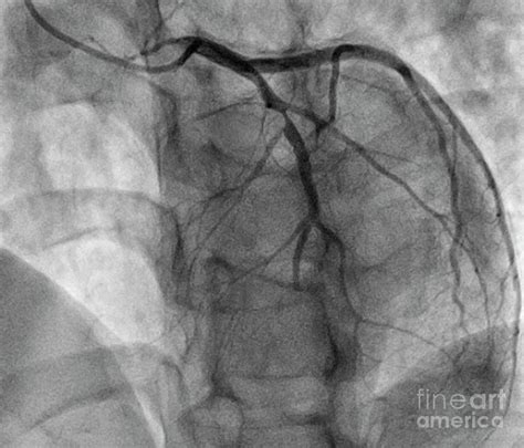 coronary artery stenosis  photograph  science photo library pixels