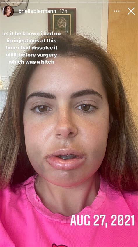 Brielle Biermanns Double Jaw Surgery Before And After Photos Life