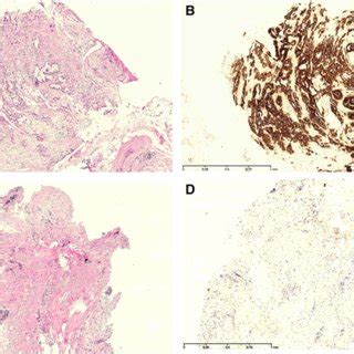 Ad Microscopic Appearance Of The Peritoneum In Peritoneal Biopsies