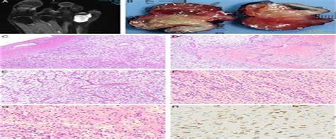 Ogt Rearranged Acral Mesenchymal Neoplasms An Emerging Enti The