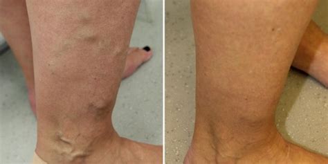 Varicose Veins Condition London Vein Centre