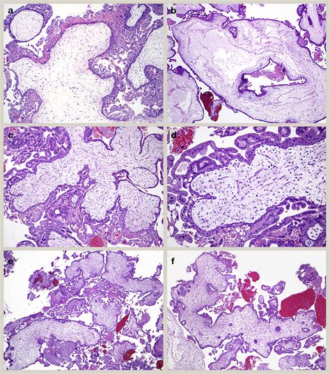 Hydatidiform Moles Differential Diagnosis Diagnostic Reproducibility