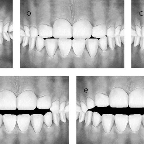 Series of images showing decreasing overbite in 1-mm increments: (a ...