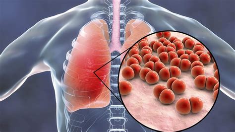 Inwazyjna Choroba Pneumokokowa Objawy I Leczenie Poradnikzdrowie Pl