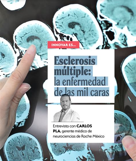 Esclerosis Múltiple La Enfermedad De Las Mil Caras Amiif