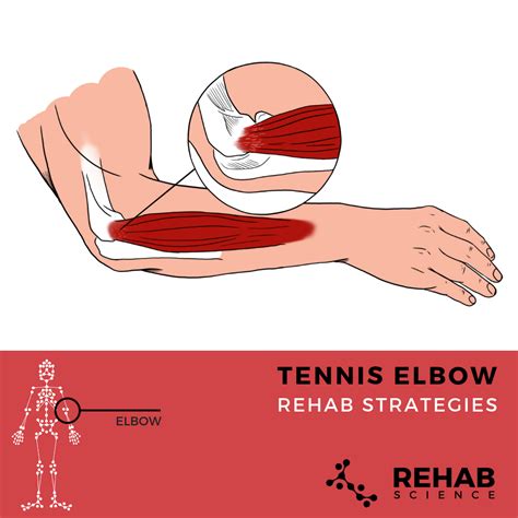 Tennis Elbow - Rehab Science