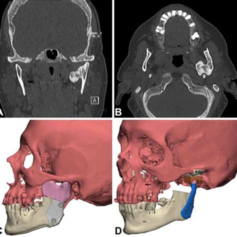 Maxillofacial Ct Axial Ct Shows The Tumor Located On The Medial Side