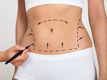 Diferencias Entre Dermolipectom A Y Abdominoplastia Cl Nica Opci N M Dica