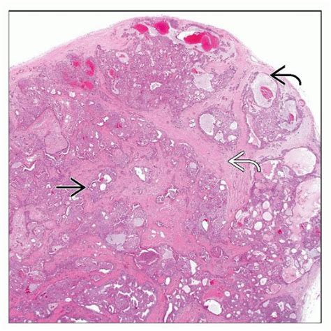 Cutaneous Mixed Tumor Chondroid Syringoma Basicmedical Key