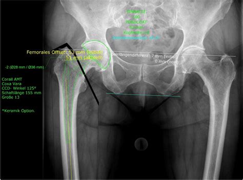 Preoperative Planning Standardised Antero Posterior View Of The Pelvis Download Scientific