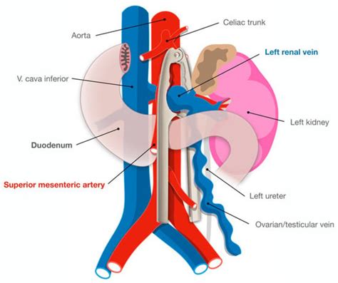 Jpm Free Full Text Interventional Management Of A Rare Combination