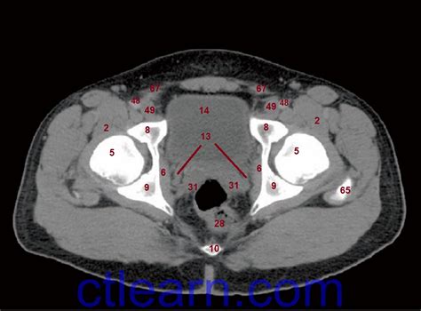 Learn Ct Scan Anatomy Ct Axial Abdomen And Pelvis Male | Hot Sex Picture