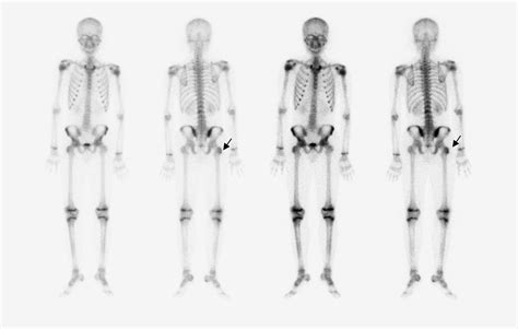 Arquivo de cintilografia óssea Dr Davi Bellan