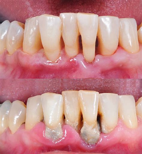 Gingivitis Before And After Treatment