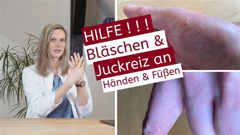 4K Juckende Bläschen an den Händen oder Füßen Handekzem Diagnose