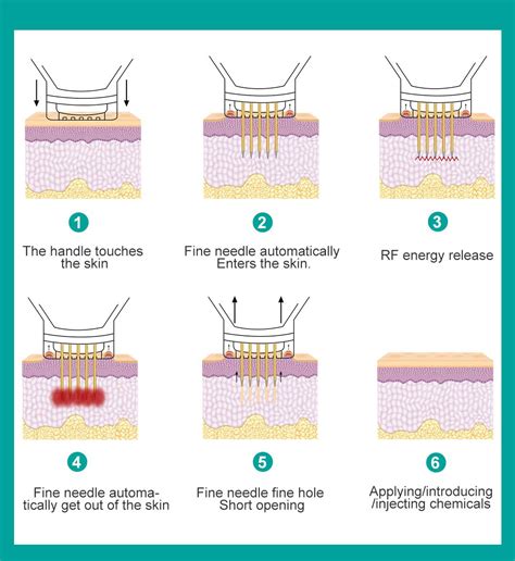 The Difference Between Rf Microneedling And Fractional Laser Treatment