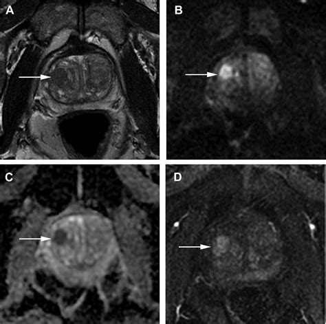 Multiparametric Mr Imaging Of The Prostate Radiologic Clinics