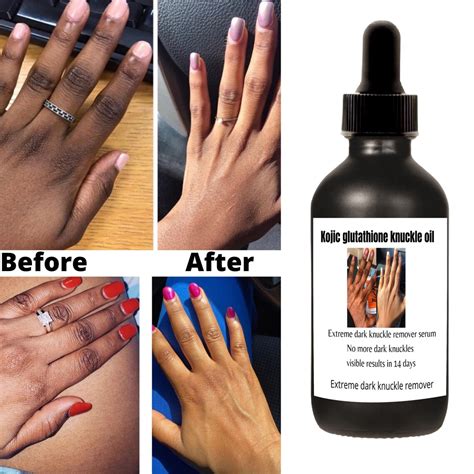 Kojic Glutathione Knuckle Whitening Serum Dark Knuckles Etsy