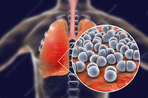 Pneumonia Caused By Streptococcus Pneumoniae Bacteria Conce Stock