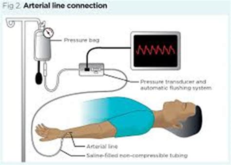 Nurs Lab Basic Hemodynamic Monitoring Flashcards Quizlet