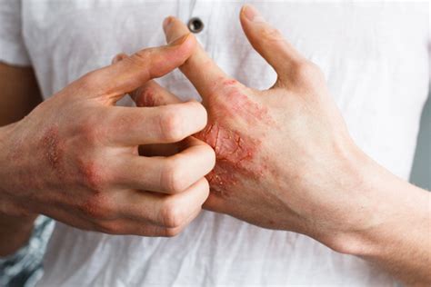 Shingles On Palms Of Hands