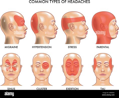 Types Of Headaches Hi Res Stock Photography And Images Alamy